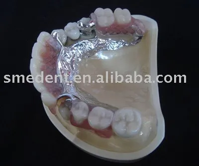 Dental magnetic attachment/Preci-vertix ype attachment