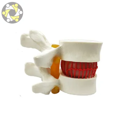 Vertebral Spine Simulator for Lumbar Disc Herniation Medical Science Model