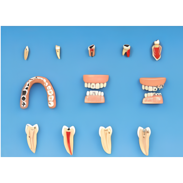 Modelo de doenças dentárias (como uma ferramenta educacional)