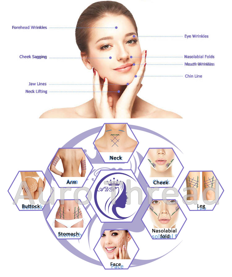 Eye Contour Cannula Pdo Thread Lift คุณภาพสูง Eye Contour Cannula Pdo ...
