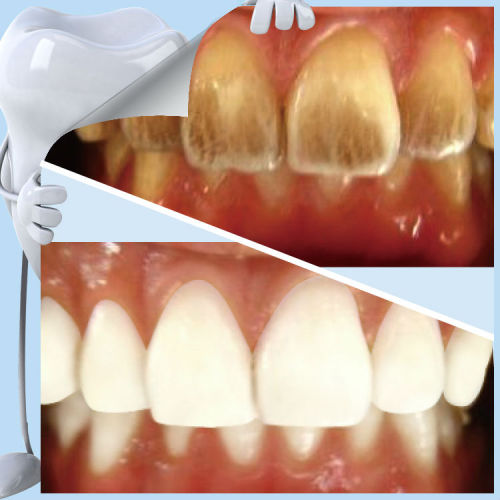 Teeth whitening and scaling removal oral hygiene