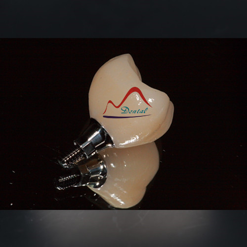 IPS E.max® crown on Implant