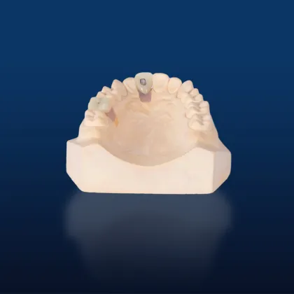 Customized Dental Implant Porcelain