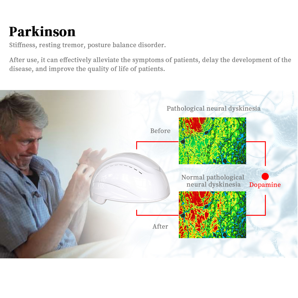 China photobiomodulation therapy helmet