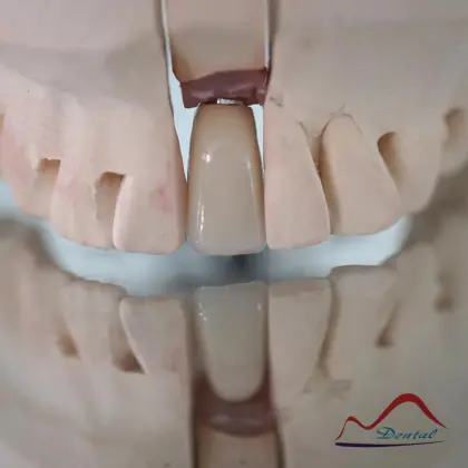Mandibular Dental Implant Crown