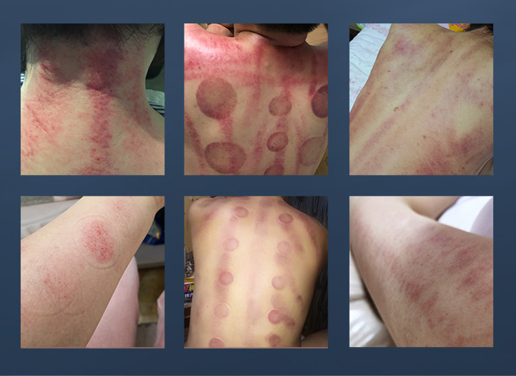 cavitation treatment near me