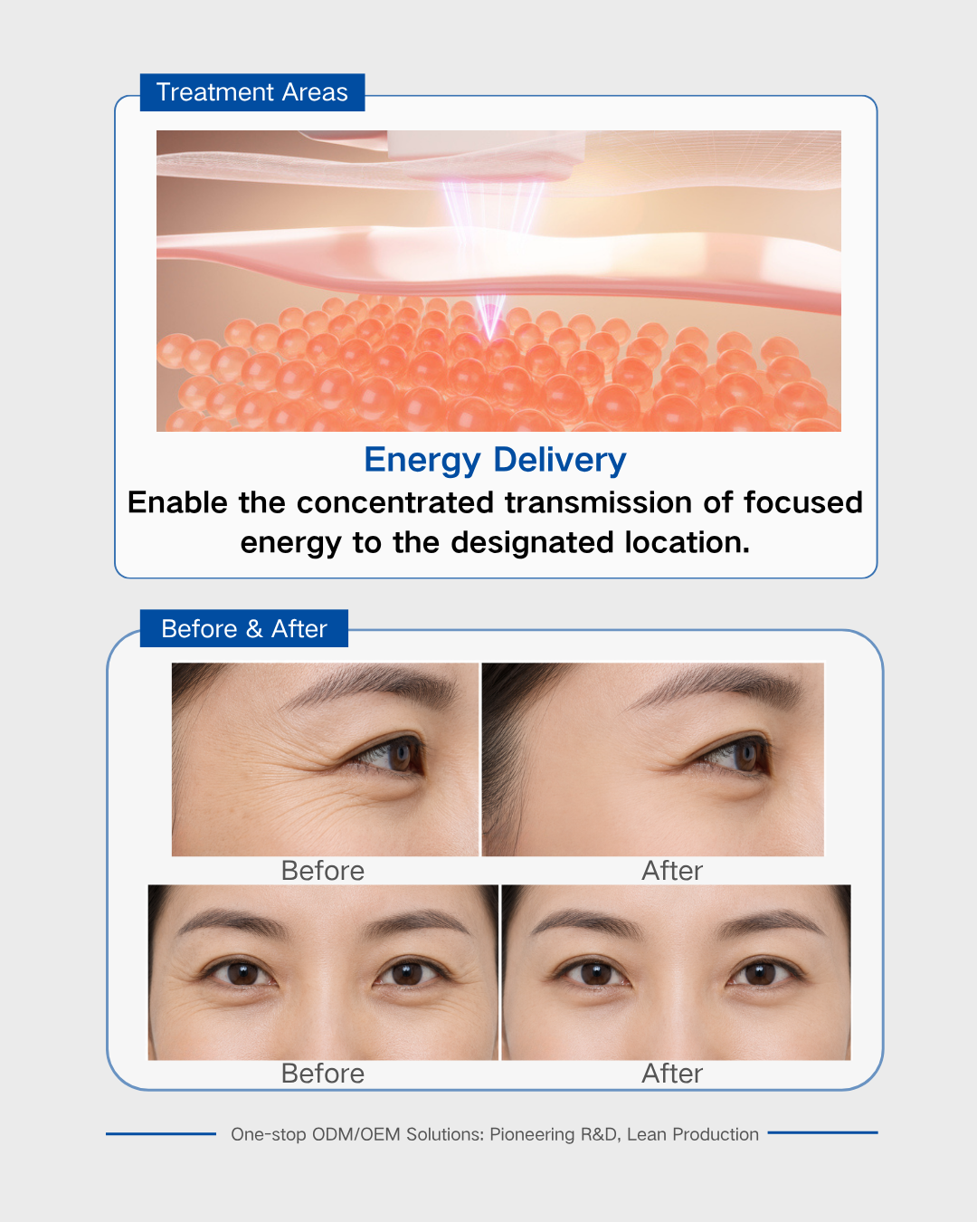 Core Component of Ultrasound Device for Fine Line Reduction-04