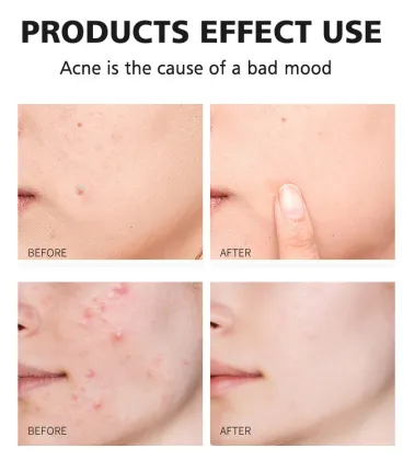 48 Patches Face Care Hydrocolloid Anti-Acne Repair Invisible Acne Patches