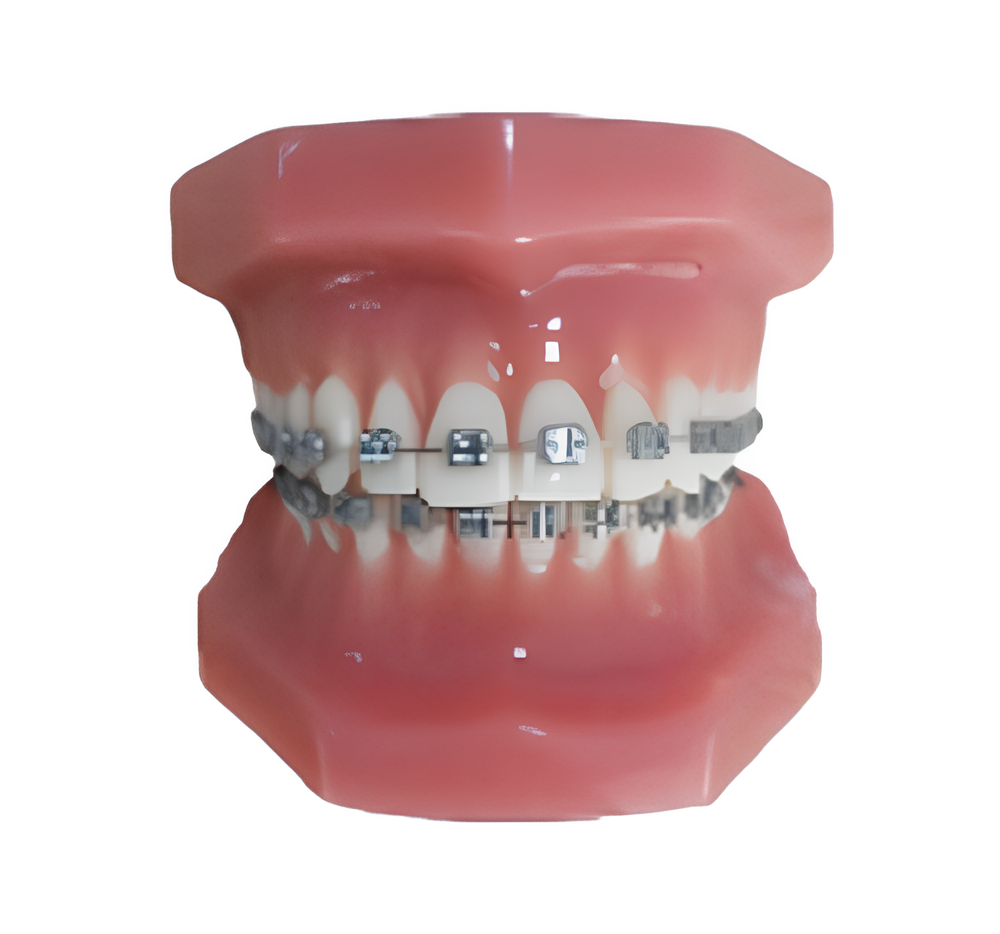 Фиксированная ортодонтическая модель (нормальная)