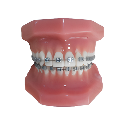 Modelo de ortodoncia fijo (normal)