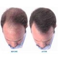 Prevent Sebaceous Hair Loss Minoxidil Powder CAS 38304-91-5