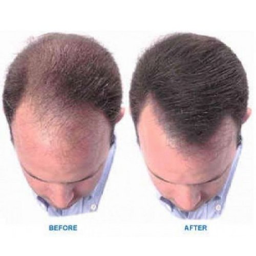 Prevent Sebaceous Hair Loss Minoxidil Powder CAS 38304-91-5