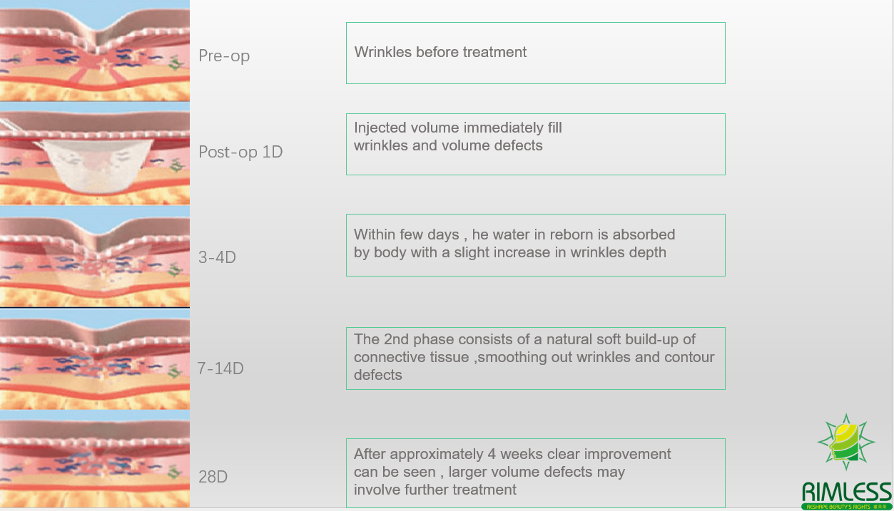 dermal fillers