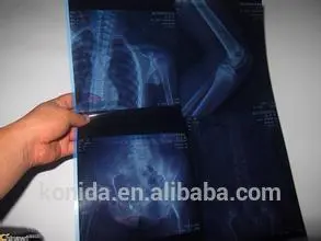 medical x-ray thermal free blue films hot blue film for fuji and agfa, best products