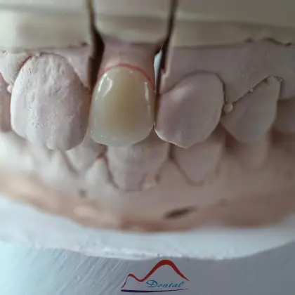 Dental Anterior Zirconia Restoration
