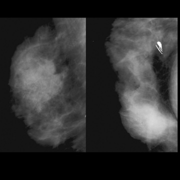 medical image film of automatic x-ray processor