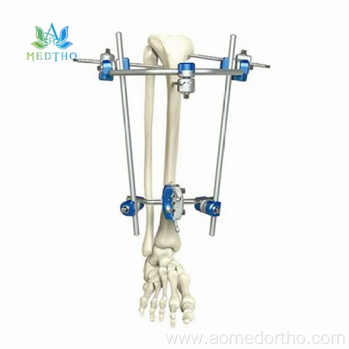 ex fix tibia China Manufacturers Suppliers Factory Exporter