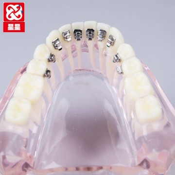 Transparent Dental Model with Various Brackets: Roth, Lingual, Ceramic, and MBT
