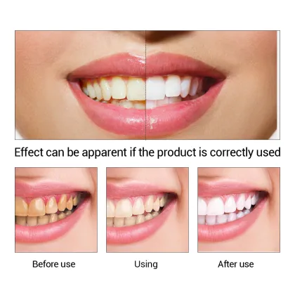 OMY LADY Teeth Whitening Essence: Best Selling Oral Hygiene Cleaning Serum in Europe