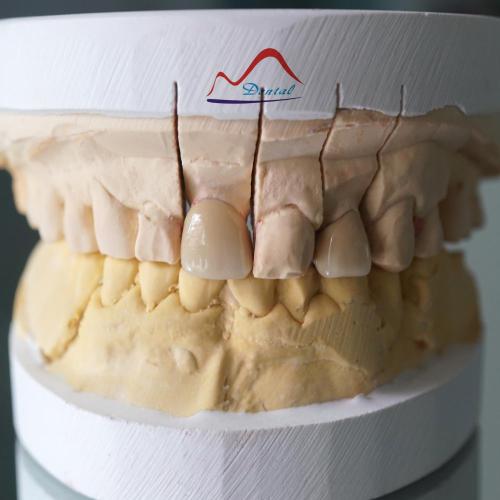 3/4 Porcelain Metal Crown