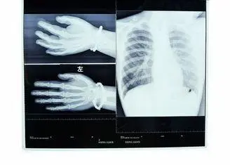 Low Fog 14in * 17in Medical Imaging Dry X-ray Transparency