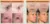 Wrinkle Removal Anti Ageing Beauty Machine