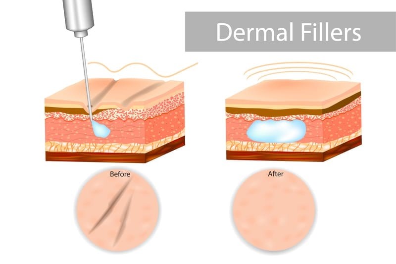 weiche Füllstoffe soft fillers