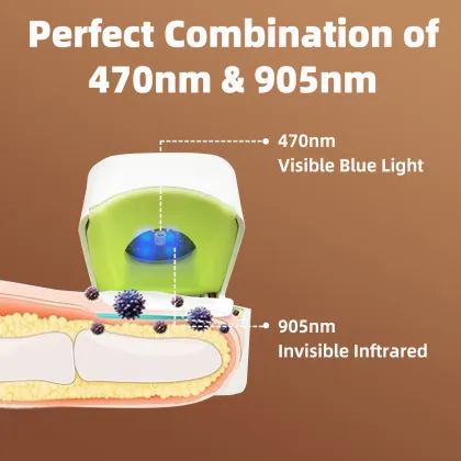 Laser Treatment Device for Nail Fungus - Onychomycosis Laser Therapy