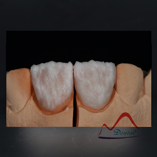 Dental IPS E.max® thin veneer