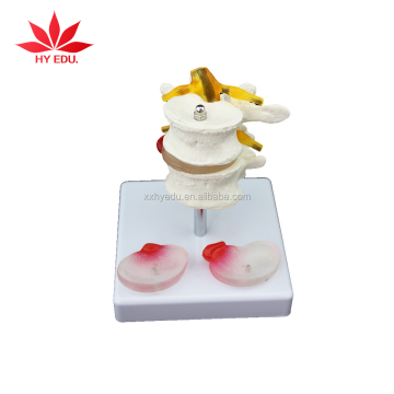 Lumbar Vertebral Model with Hernia and Prolapsed Disc for Medical Teaching