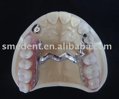 Dental Attachment / Dental magnetic attachment / Annker type attachment