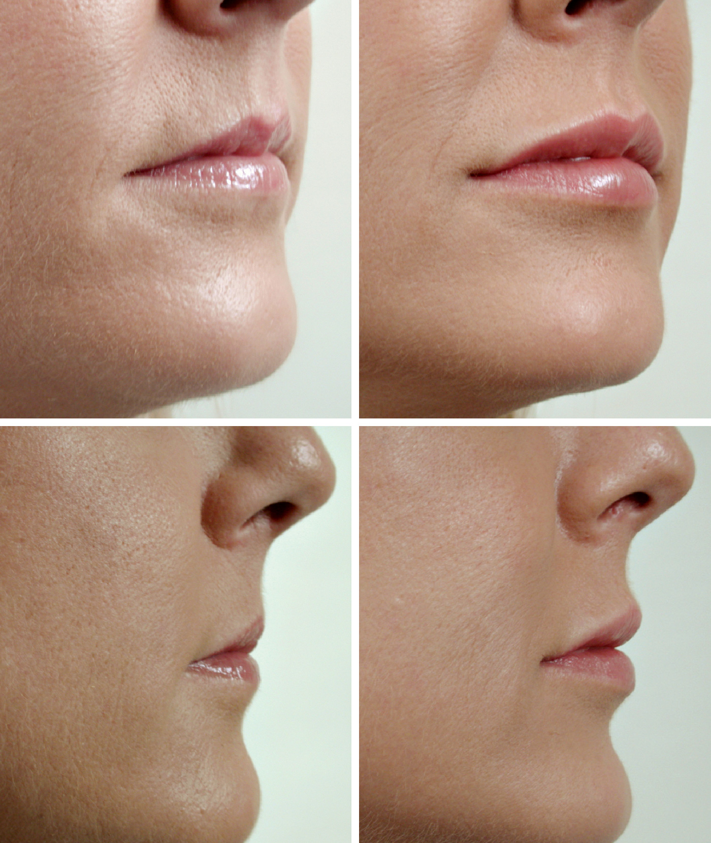 Chemical Lip Enhancement