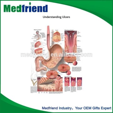 China Wholesale Merchandise Understanding Ulcers Chart