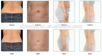 Sincoheren cavitaion and RF fast slimming skin tightening machine