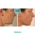 Non-surgery Natural Dermal Filler For Cheek Contouring