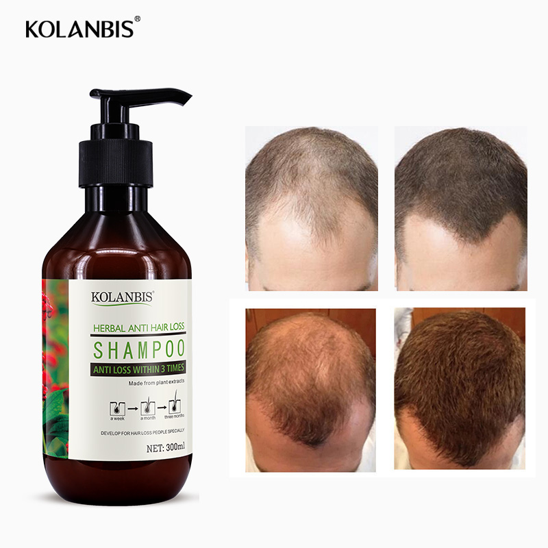 Anti Hair Loss Shampoo Thick Fast Hair Growth Hair Restore Treatment Organic Hair Regrowth Protein Product