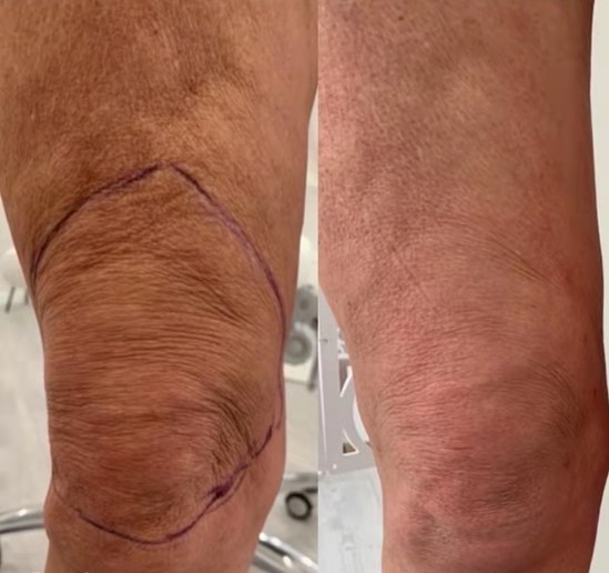Reborn PLLA Dermal Filler For Knee Rejuvenation