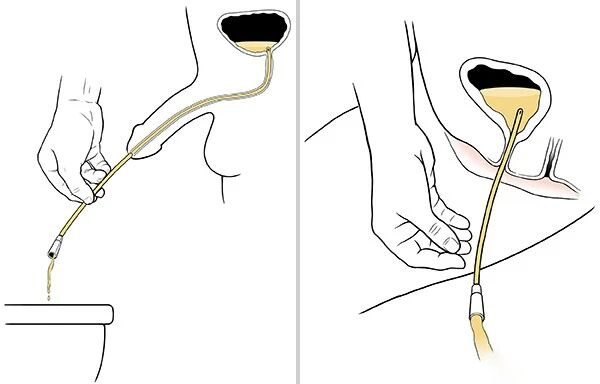 Intermittent catheter (3)