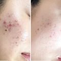 Mặt nạ kiểm soát dầu axit salicylic sau khi điều trị bằng ánh sáng xanh