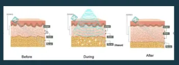ultrasonic cavitation beauty machine