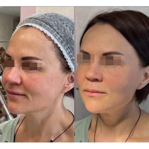 Collagen Stimulator Reborn PLLA Filler for Face Skincare