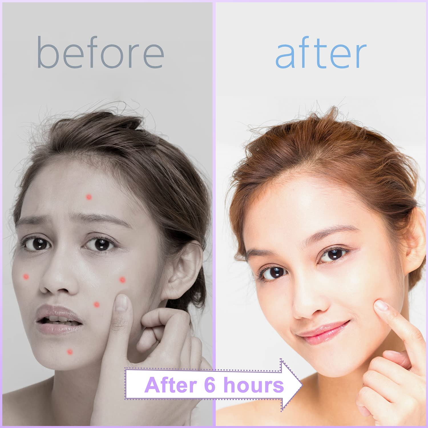 Pample Shangyang Mighty และ Invisible Acne Patch Patch Patch Pample Patch ...
