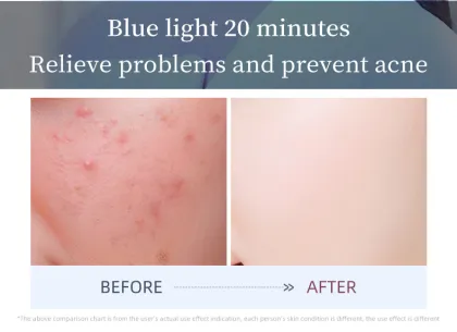 Light Therapy Facial Mask