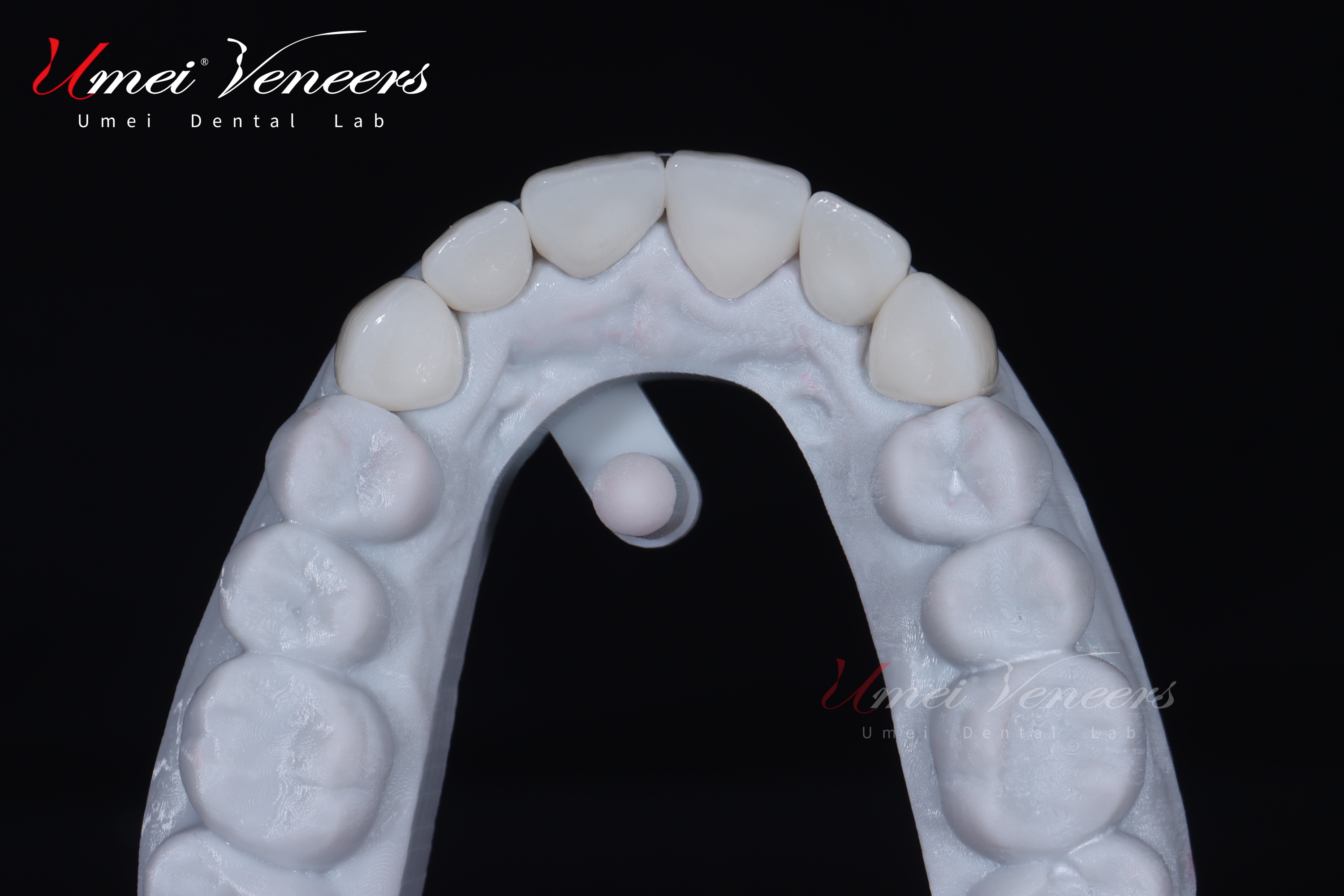 E.max Layered Veneers