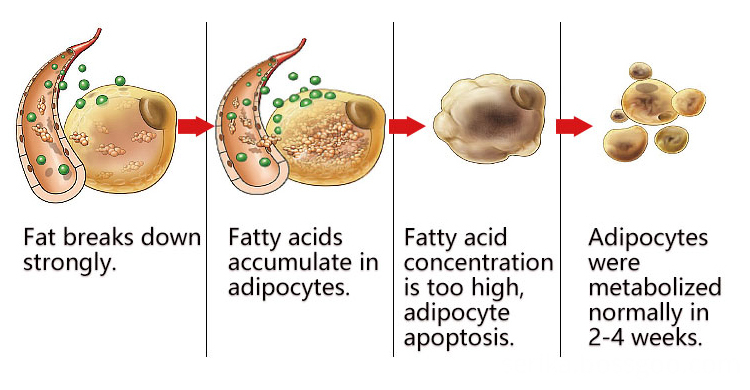 Cellulite Reduction Slimming