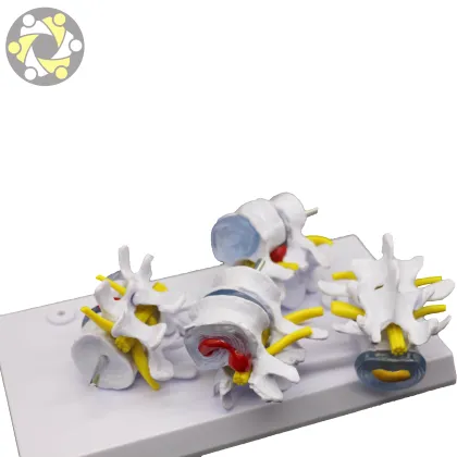 Pathological 4-Stage Human Lumbar Vertebrae Spine Disease Model