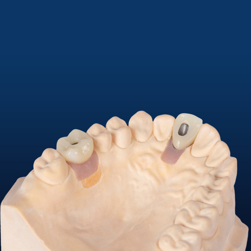 Dental Implant Crown, Dental Implant Zirconia crown,Dental Implant Emax crown,Dental Implant Bridge