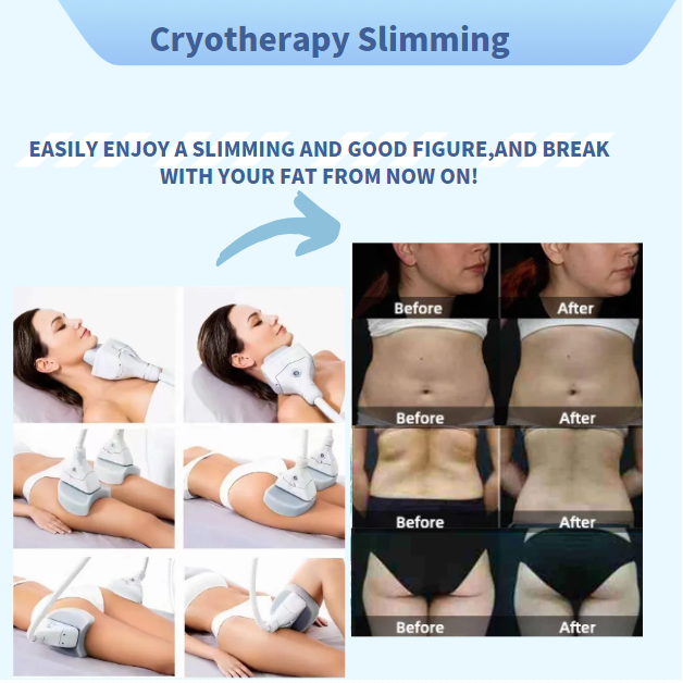 Effection of cryolipolysis machine