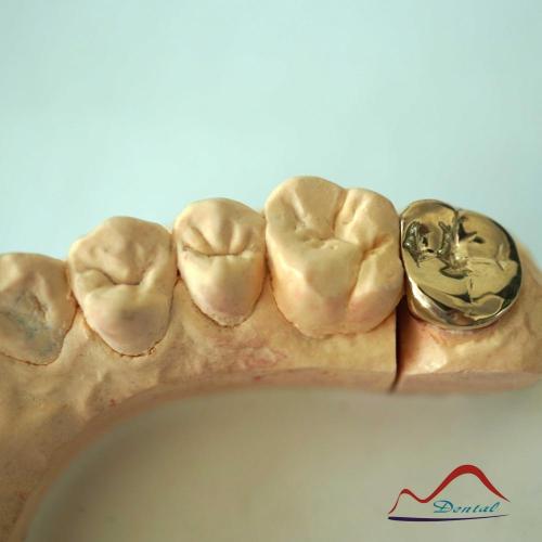DENTAL Molar Gold Onlay