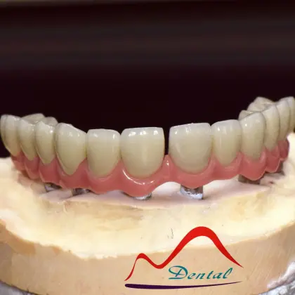 Malo Implant Bridge Restoration